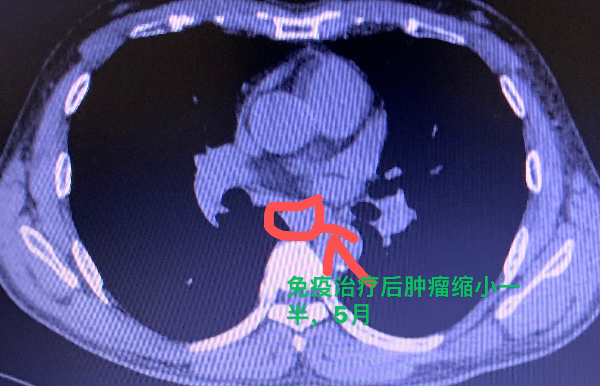 免疫治疗肿瘤减小一半， 为手术带来机会