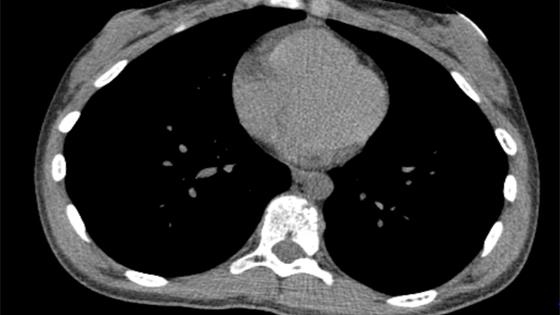 14岁少女患鸡胸，手术后鸡胸被矫正