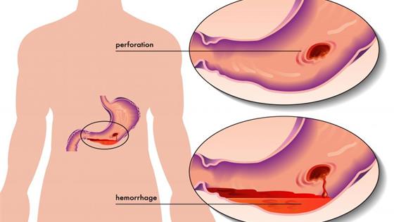 这5种食物，会损伤胃部健康，在喜欢也要少吃，需了解
