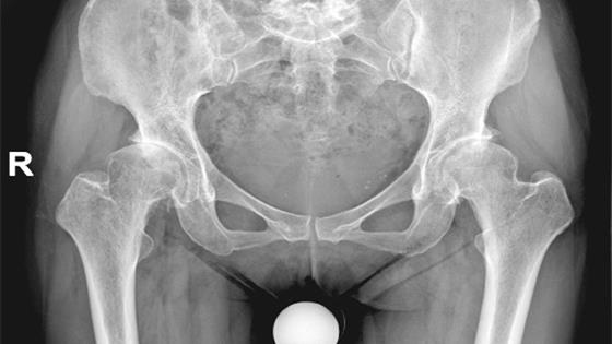 妇女股骨头无菌性坏死做关节置换术效果好