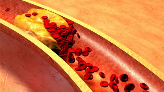 为什么同样吃红烧肉，有的老人活过100岁，有的老人却是高血脂？