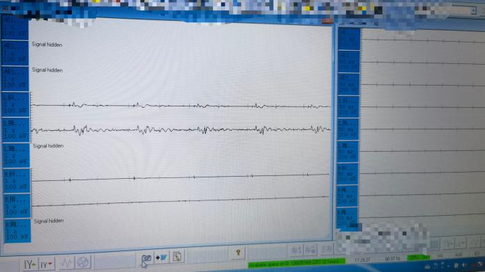 唤醒沉睡大脑的钥匙，脊髓电刺激技术为慢性昏迷患者带来新希望