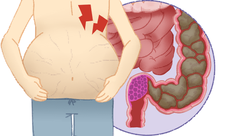 勇闯生命禁区！单孔腹腔镜微创技术帮助3.5厘米超低位直肠癌患者“去瘤保肛”