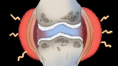 从“低钙”到“高钙危象”  医生提醒：不当“补钙”可能适得其反