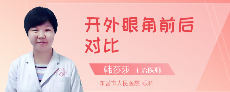 开外眼角前后对比