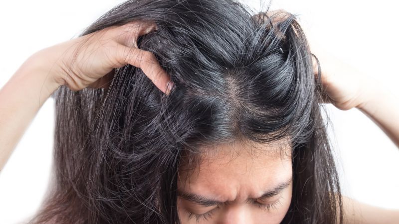 头上为什么会有大块的头皮屑