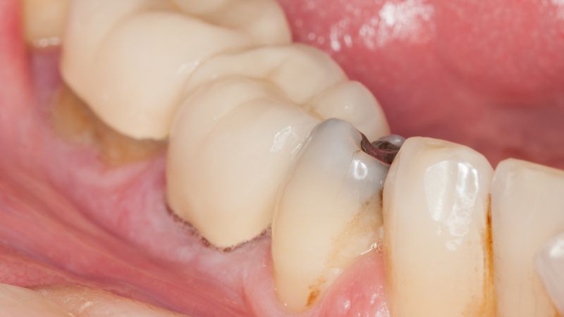 牙齿黄怎么办有什么小窍门