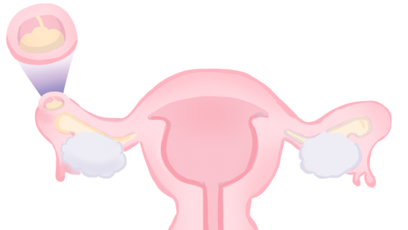 不出血小腹隐痛是宫外孕么