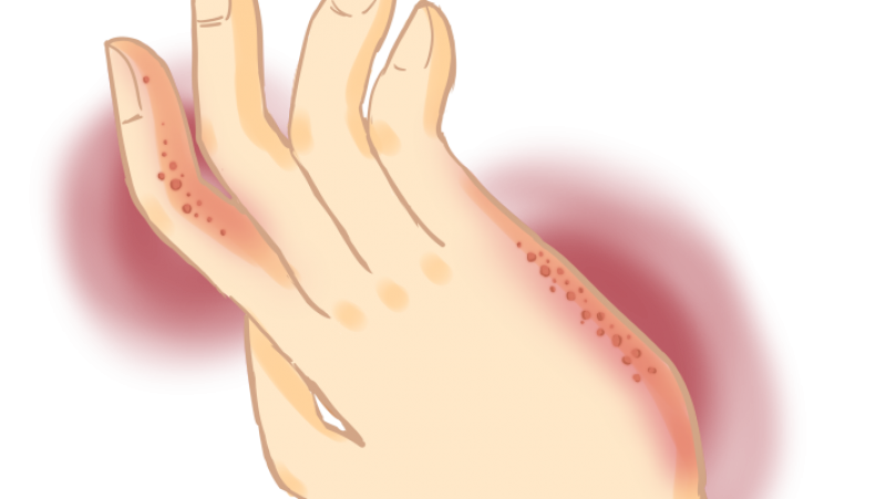 汗疱疹是勤洗手还是少沾水