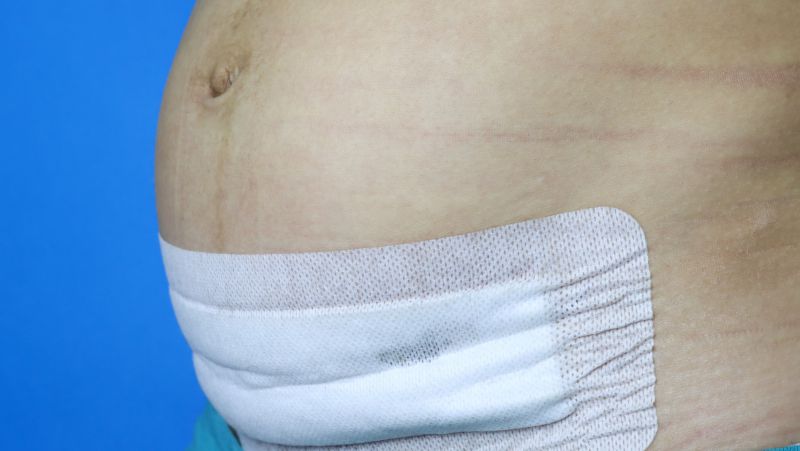 剖腹产刀口不疼附近肉疼要紧吗