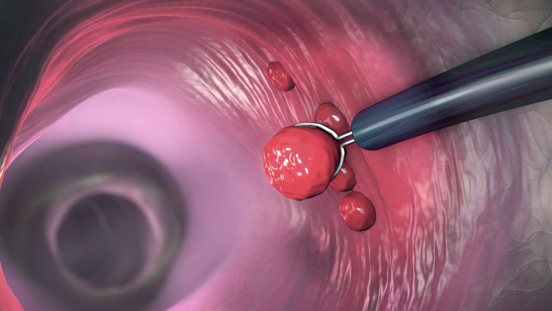 结肠息肉切除后应注意什么事项