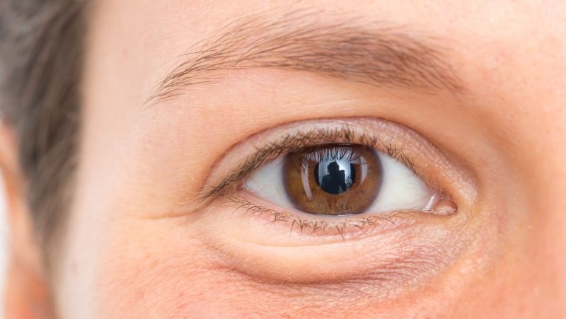 如何理疗治疗眼袋