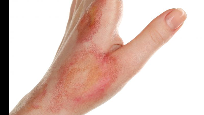 中度烧烫伤的特征