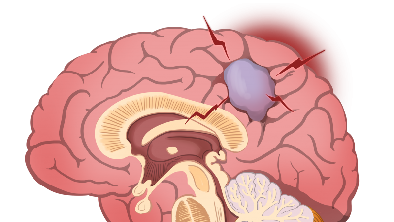 肿瘤毗邻生命中枢！南方医院增城院区神经外科实施高难度显微镜下全切术成功救治
