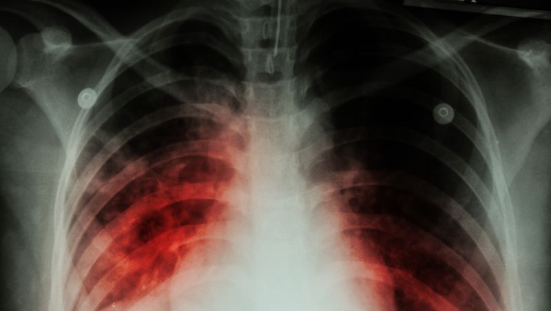 肺ct能检查出肺癌吗？肺部斑片影是肺癌吗？