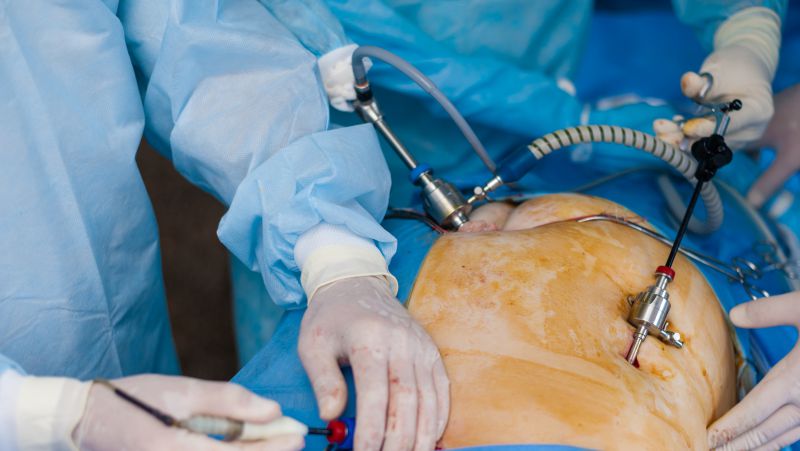 腹腔镜手术几天拆线，疼吗?